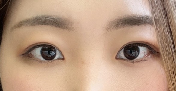 眼部剛做完綜合術(shù)后需要注意什么